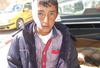 Bitlis'te eve giren porsuk çocuğun yanağını kopardı