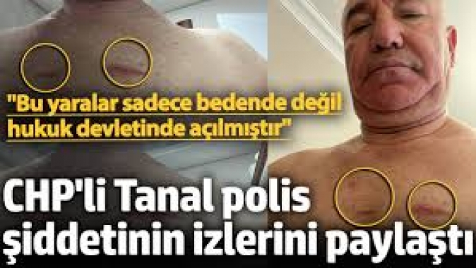CHP'li Tanal polis şiddetinin izlerini paylaştı